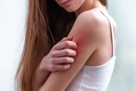 The symptoms of heat rash are often the same in adults and children 