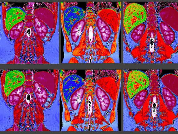 Multiparametric maps of the kidneys, showing levels of scarring and inflammation. Because theyre fluid filled they appear purple and white and nestled below the liver (green/blue in the different images)