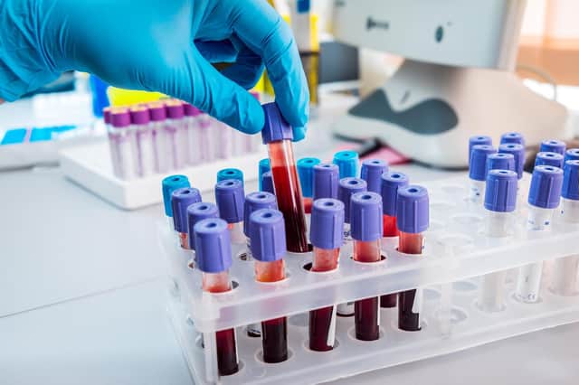 Scientists hope their new discoveries will end up allowing GPs to order a blood test to ascertain cancer, or cancer spread, in some patients