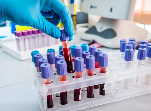 Scientists hope their new discoveries will end up allowing GPs to order a blood test to ascertain cancer, or cancer spread, in some patients