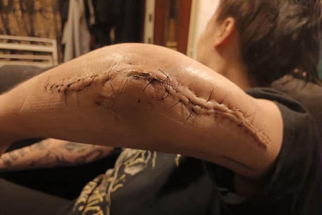 Sharne Carr's elbow after her extensive repair operation at the JR Hospital, Oxford
