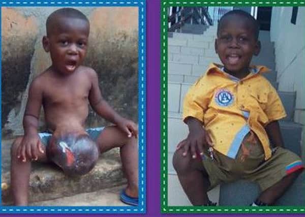 Ethan Suglo, three, from Ghana, has exomphalous, a rare condition where the intestines and other internal organs grow outside the abdomen wall. NNL-160504-143739001